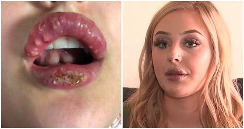 Multiple Women Left With Swollen Infected Lips Following Botched Injections